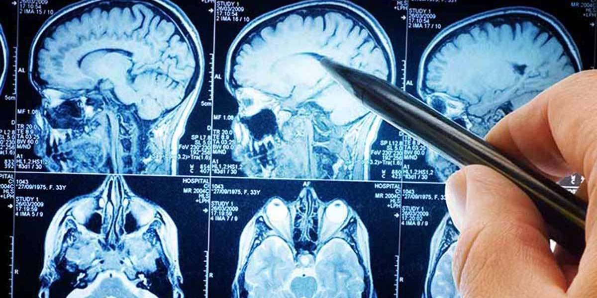 Brain Tumour Treatment in Singapore