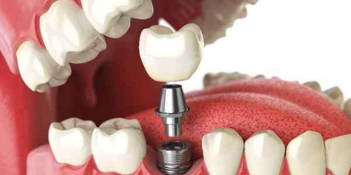 Replace Missing Teeth Quickly with Advanced Implant Options