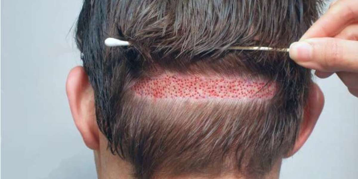 Hair Transplant Cost in Lahore: What You Should Expect in 2025