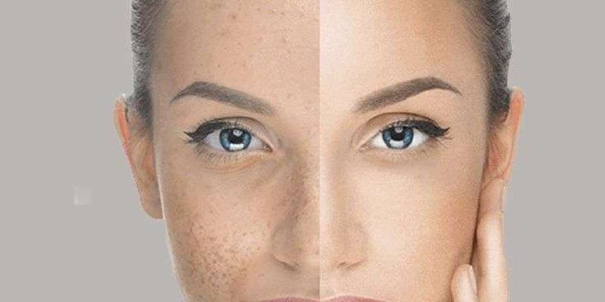 Achieve a Glowing Complexion with Advanced Whitening Solutions in Islamabad