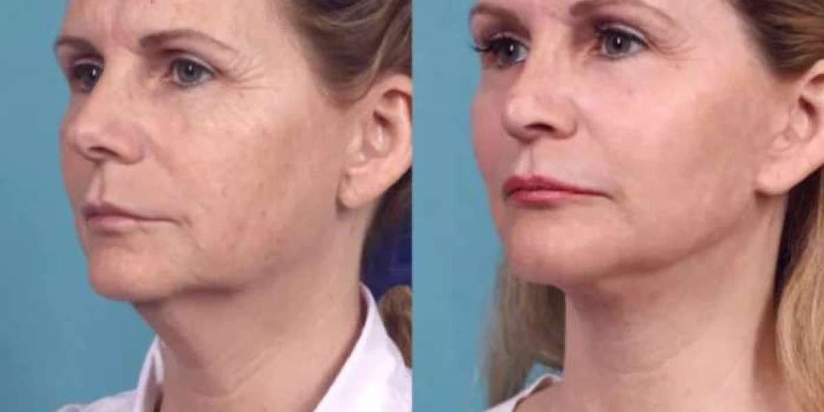 Chemical Peel Treatment in dubai: Treating Rough and Uneven Skin